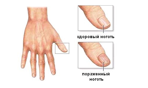 Экзема на руках чем питаться