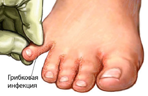 Как лечить вылечить грибок