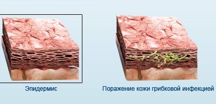 Помощник от экзодерил