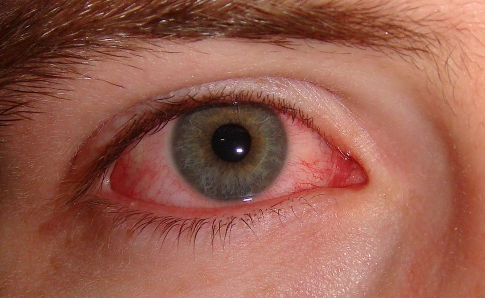 Грибок глаз симптомы и лечение 13