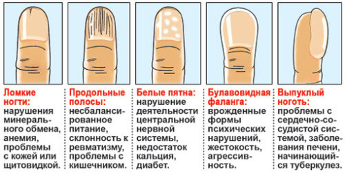 Нарушения ногтей