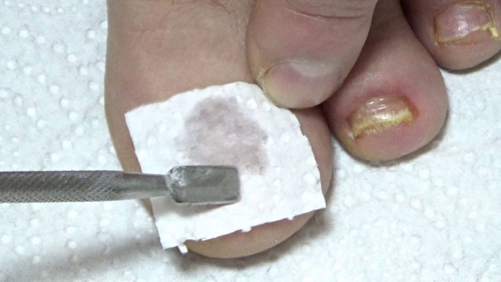 Уход за ногтями ногами лечение грибка ногтей